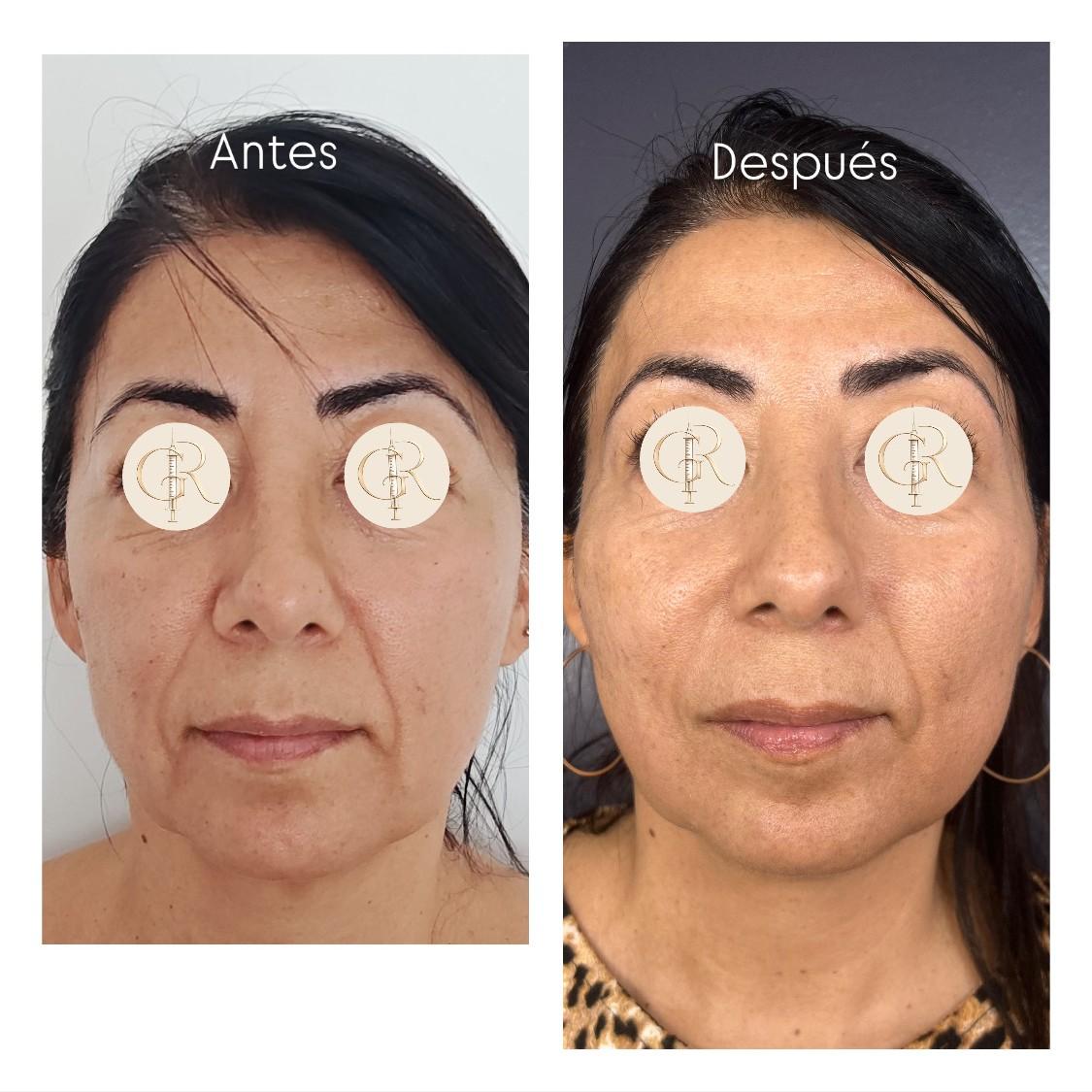 Endolifting: Lifting sin Cirugía