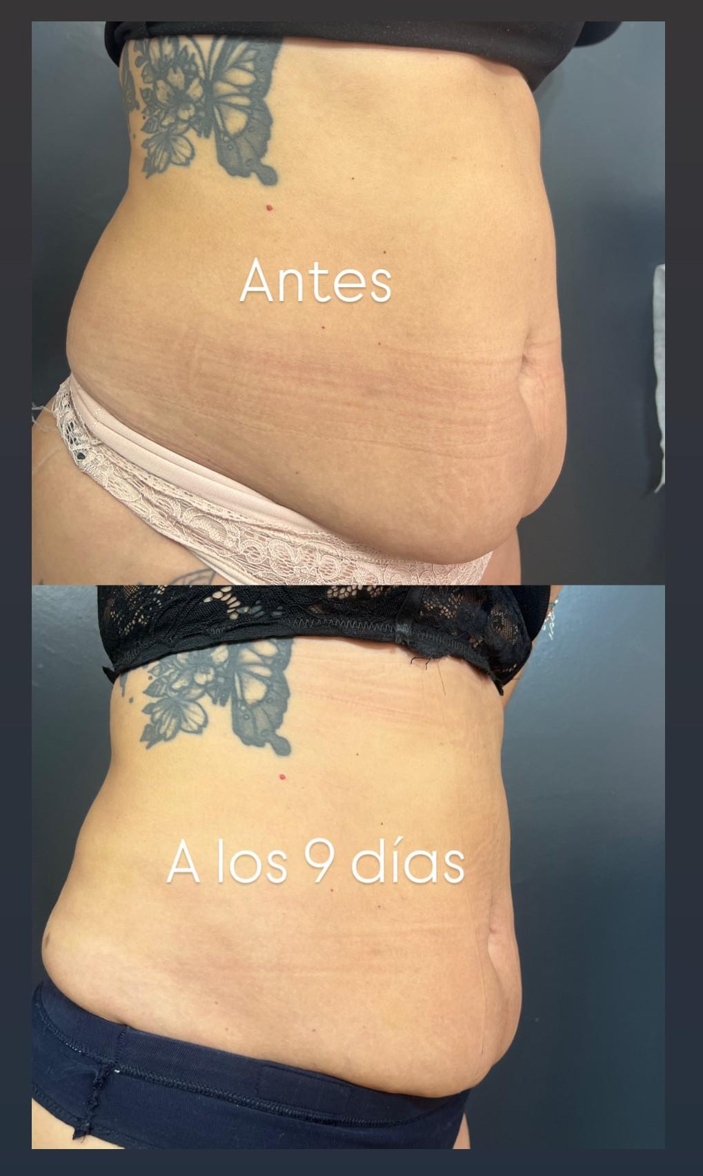 MELA Láser