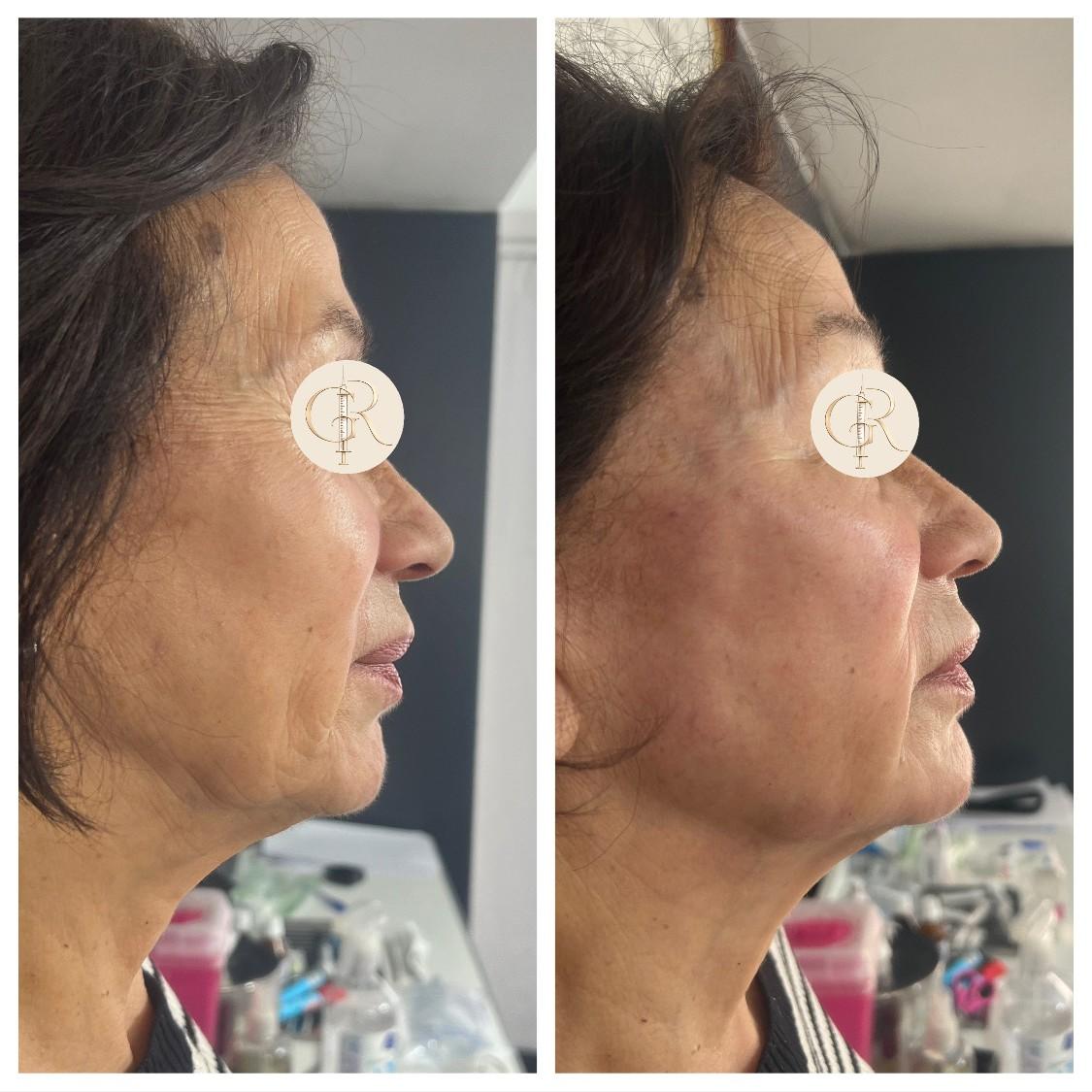 Reposición Facial