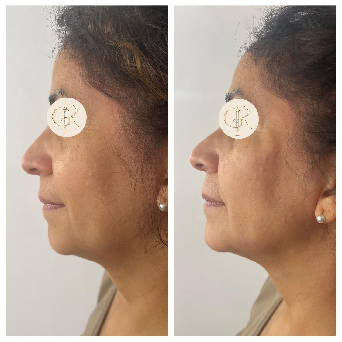 Reposición Facial