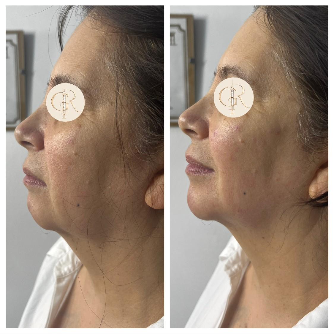 Reposición Facial