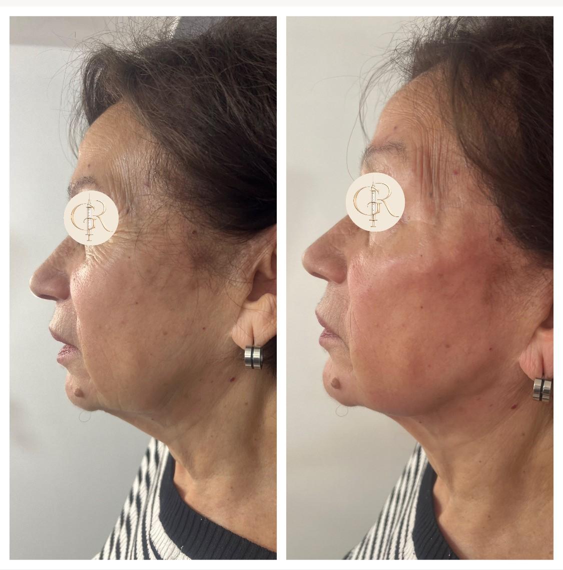Antes y después tratamiento facial
