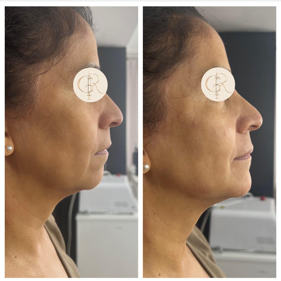 Reposición Facial