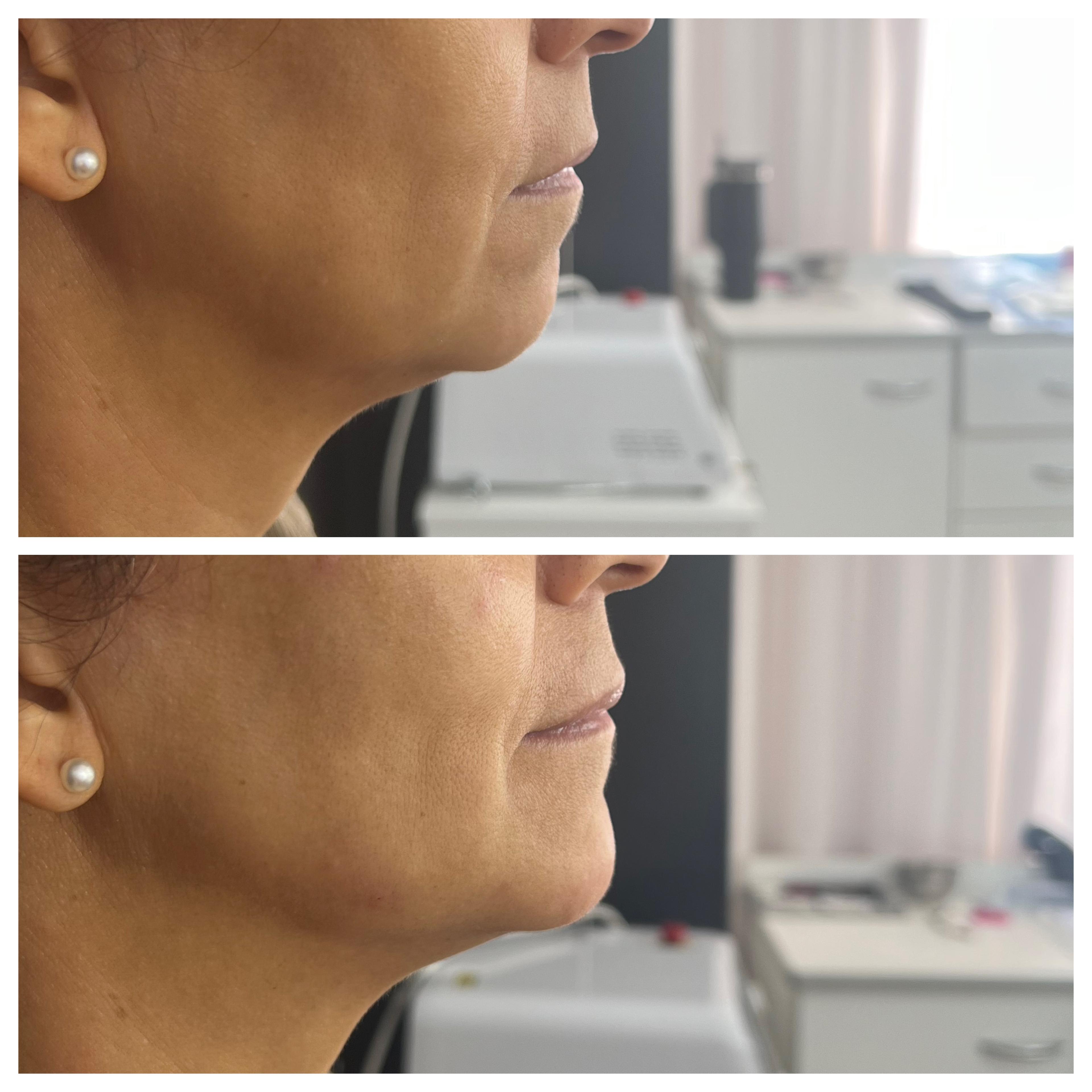 Reposición Facial