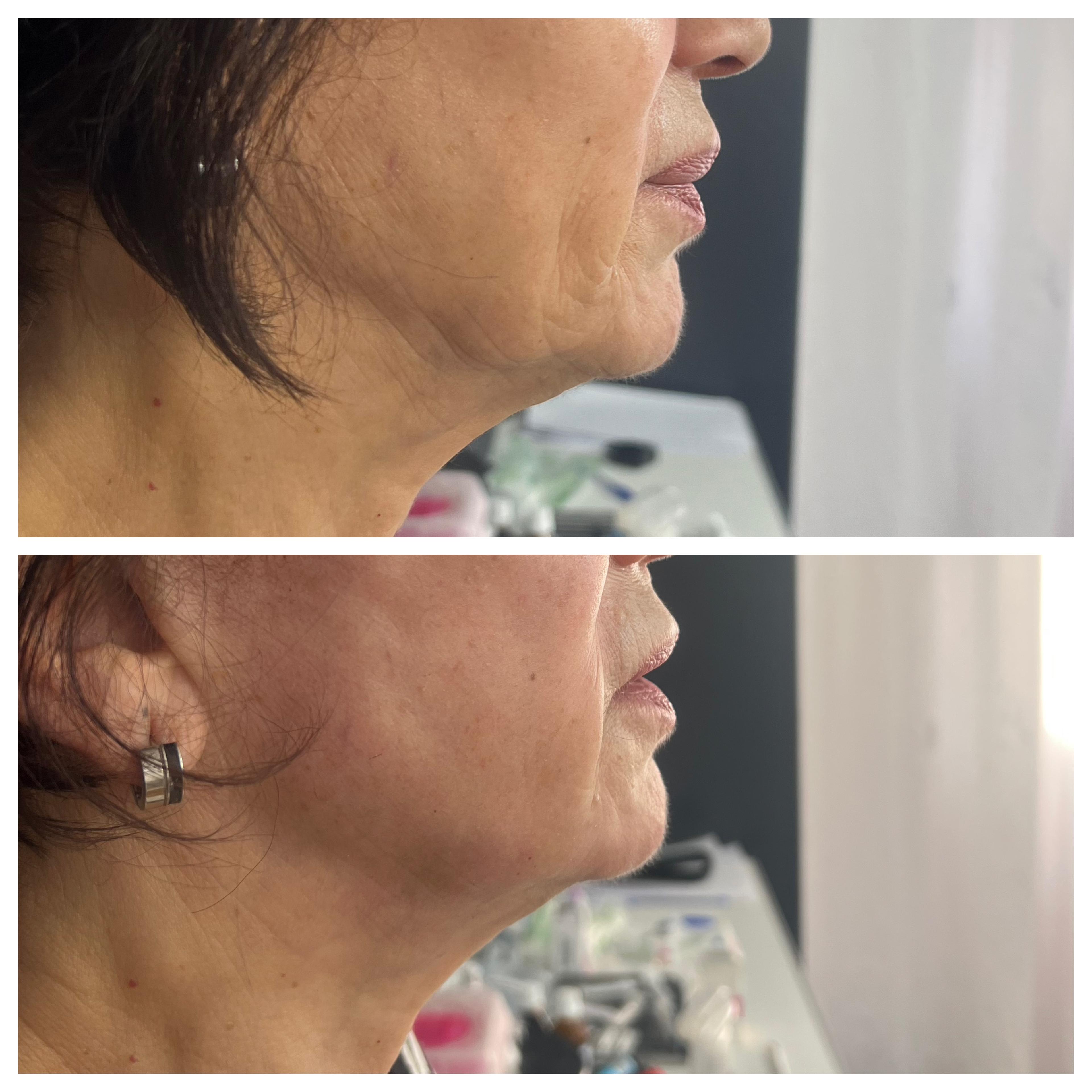 Reposición Facial