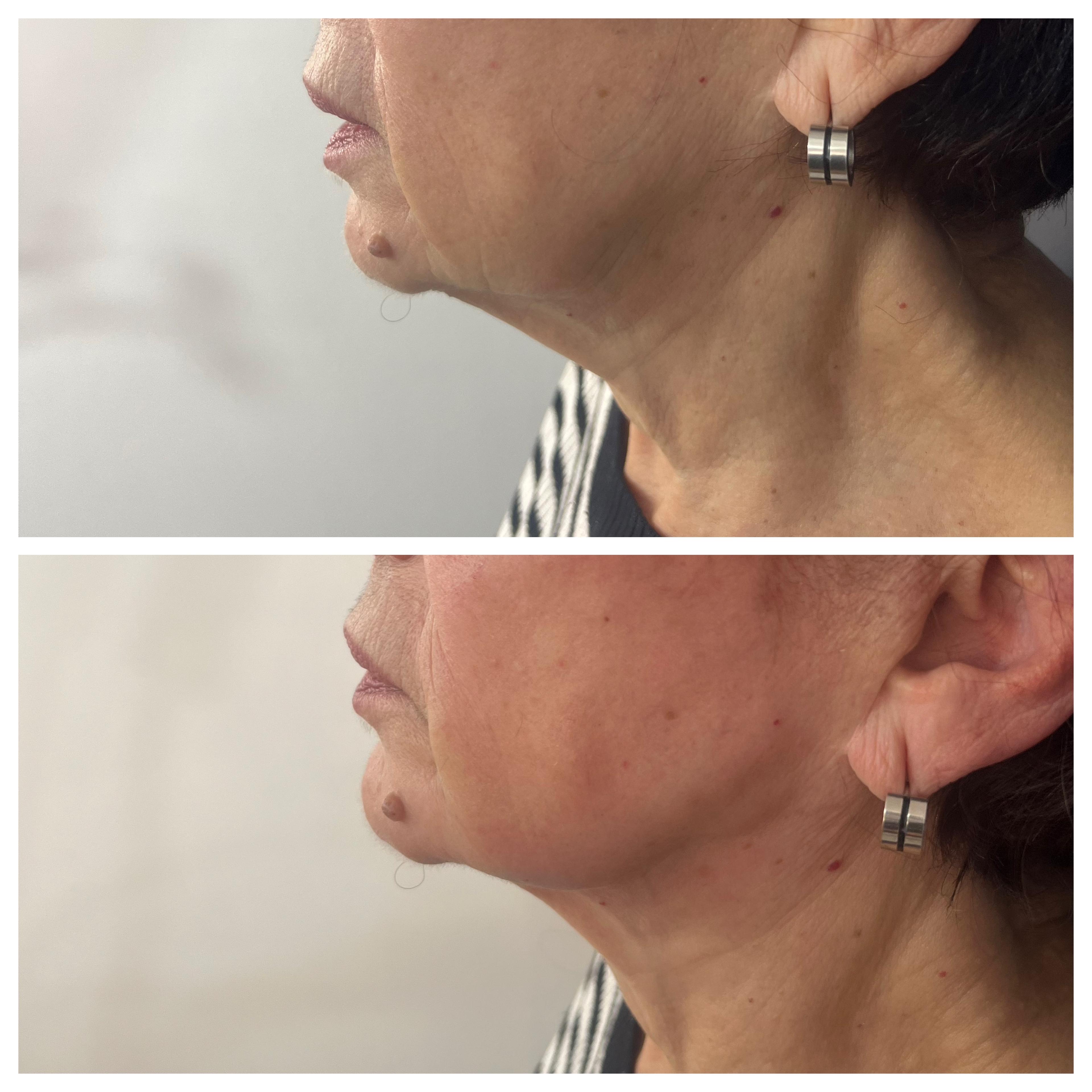 Reposición Facial